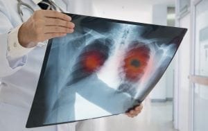 Doctor Holding Up A Lung Cancer X-Ray
