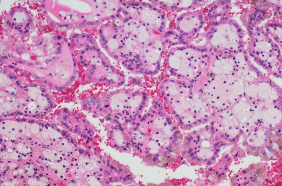 Kidney cancer cells
