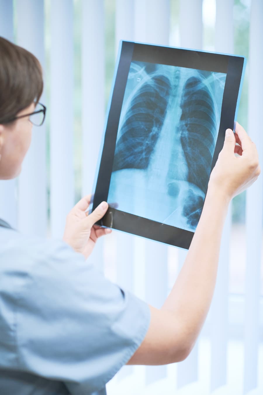 doctor looking at an x-ray for lung cancer